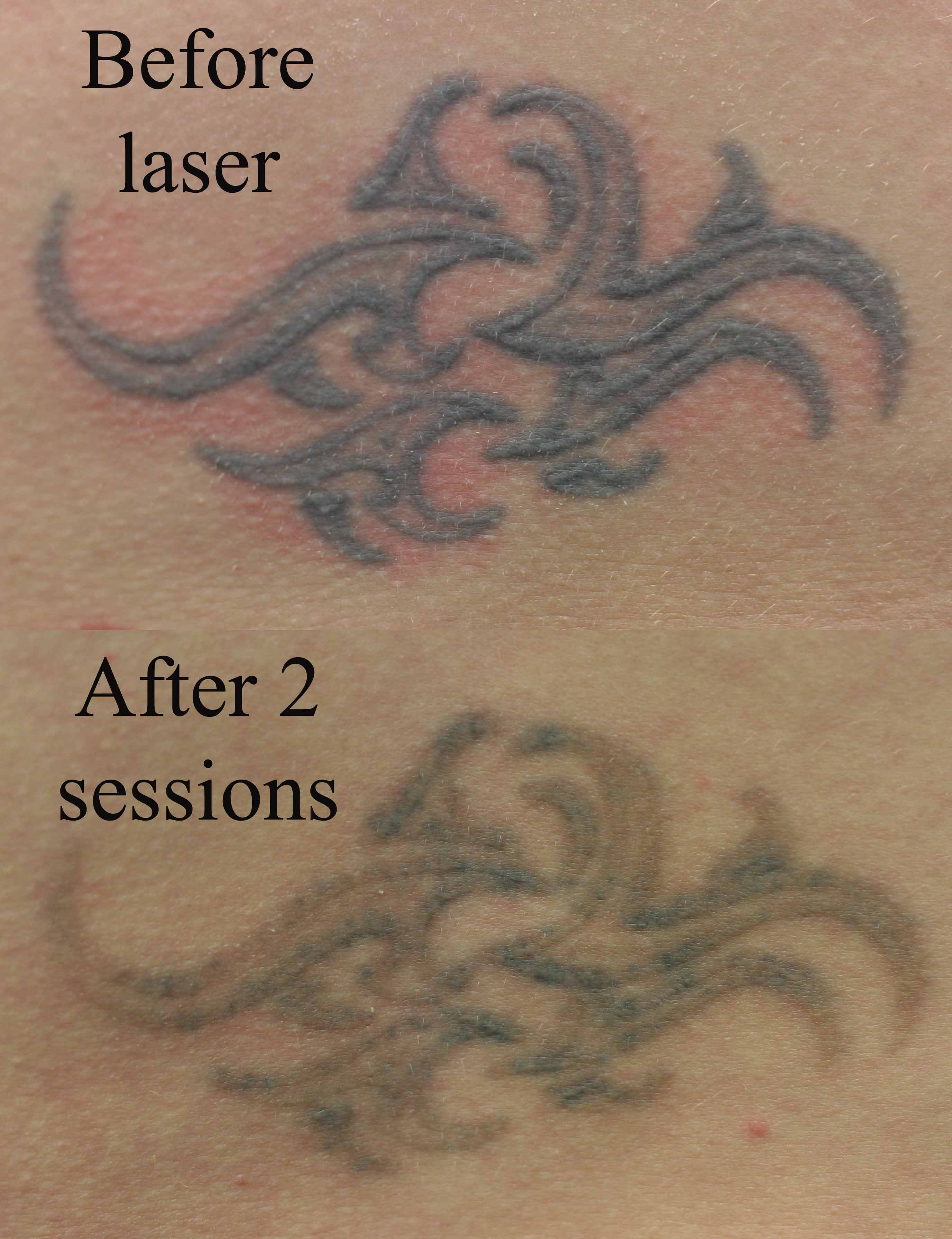 Laser  Tattoo Arts From www.tattube.com